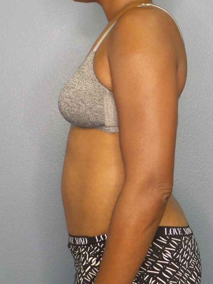 Abdominoplasty Before & After Patient #3665