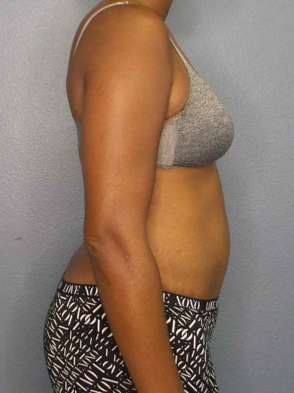 Abdominoplasty Before & After Patient #3665