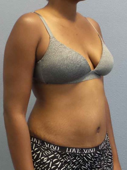 Abdominoplasty Before & After Patient #3665