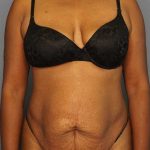 Abdominoplasty Before & After Patient #3665