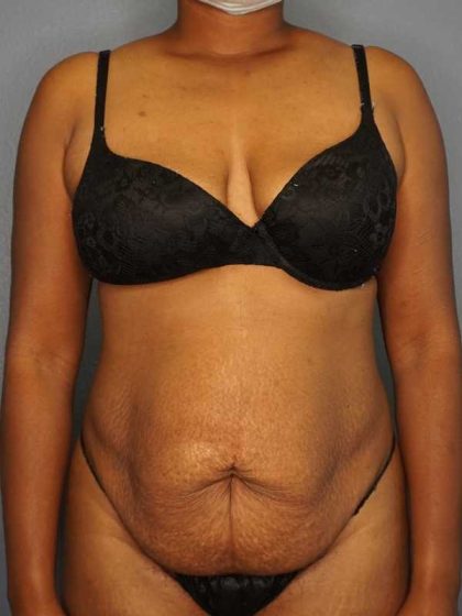 Abdominoplasty Before & After Patient #3665