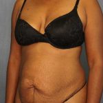 Abdominoplasty Before & After Patient #3665