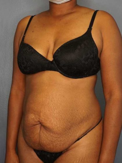 Abdominoplasty Before & After Patient #3665