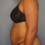Abdominoplasty Before & After Patient #3665