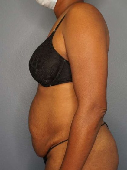 Abdominoplasty Before & After Patient #3665