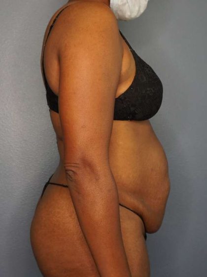 Abdominoplasty Before & After Patient #3665