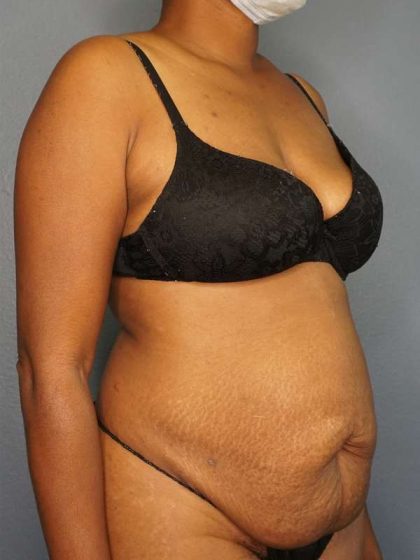 Abdominoplasty Before & After Patient #3665