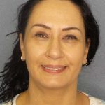 Liposuction of the Neck Before & After Patient #8307