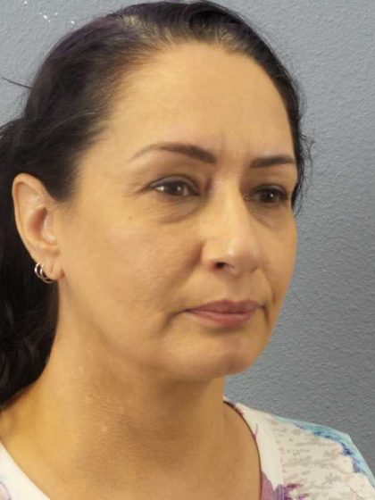 Liposuction of the Neck Before & After Patient #8307