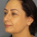 Liposuction of the Neck Before & After Patient #8307