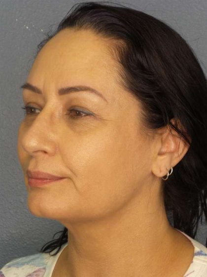 Liposuction of the Neck Before & After Patient #8307
