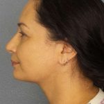 Liposuction of the Neck Before & After Patient #8307