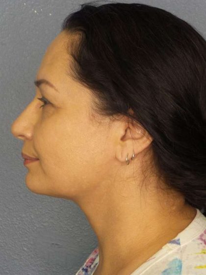 Liposuction of the Neck Before & After Patient #8307