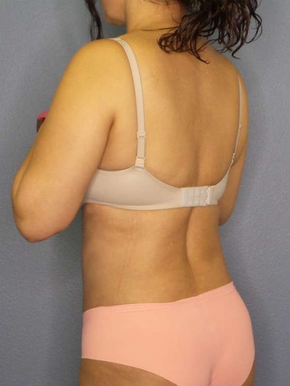 Liposuction Female Before & After Patient #7885