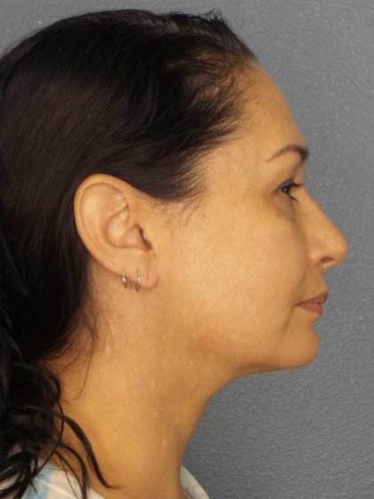 Liposuction of the Neck Before & After Patient #8307