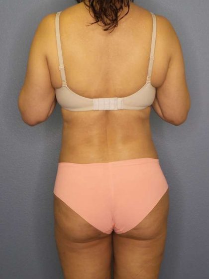 Liposuction Female Before & After Patient #7885