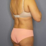 Liposuction Female Before & After Patient #7885