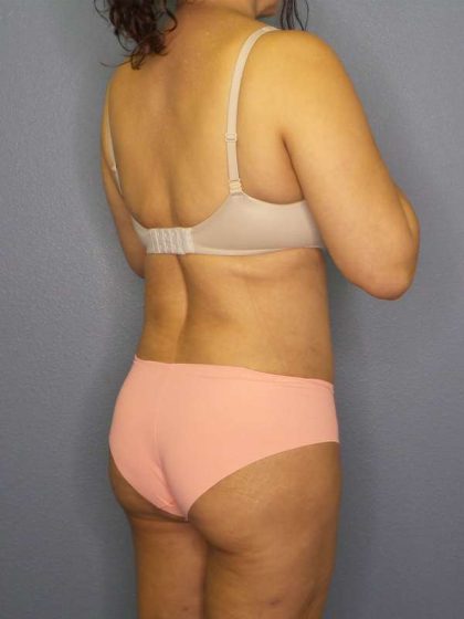 Liposuction Female Before & After Patient #7885