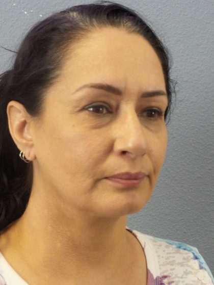 Liposuction of the Neck Before & After Patient #8307
