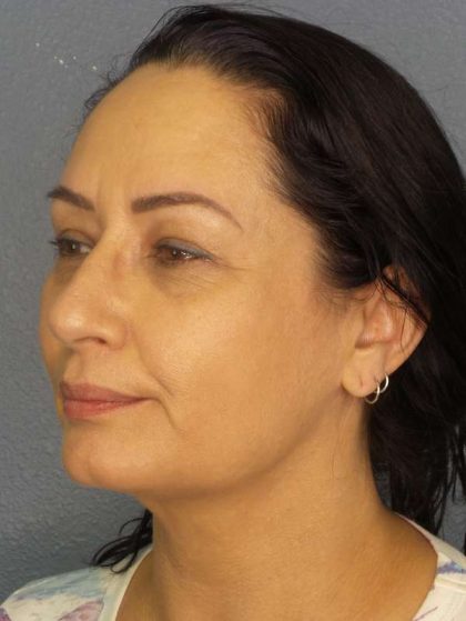 Liposuction of the Neck Before & After Patient #8307