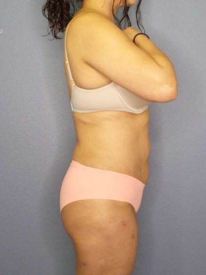 Liposuction Female Before & After Patient #7885
