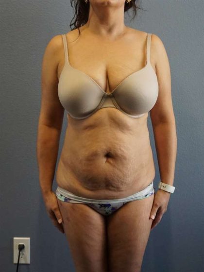 Liposuction Female Before & After Patient #7885