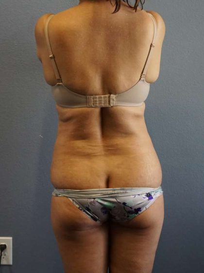 Liposuction Female Before & After Patient #7885