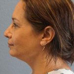 Liposuction of the Neck Before & After Patient #8307