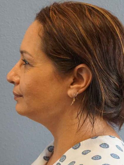 Liposuction of the Neck Before & After Patient #8307