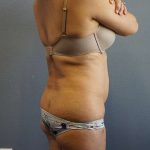 Liposuction Female Before & After Patient #7885