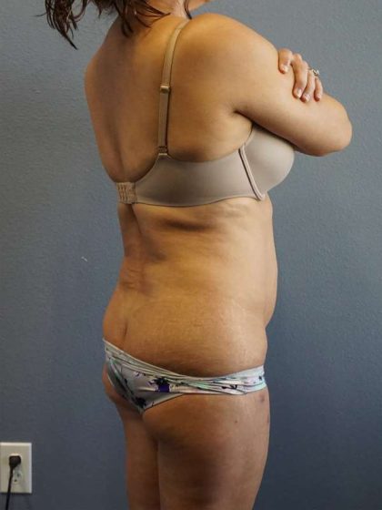Liposuction Female Before & After Patient #7885