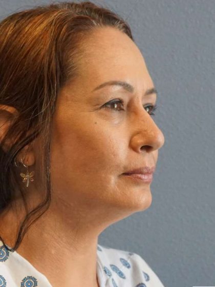 Liposuction of the Neck Before & After Patient #8307