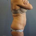 Liposuction Female Before & After Patient #7885