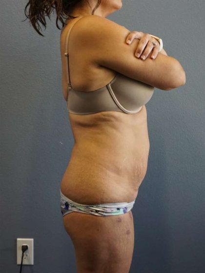 Liposuction Female Before & After Patient #7885