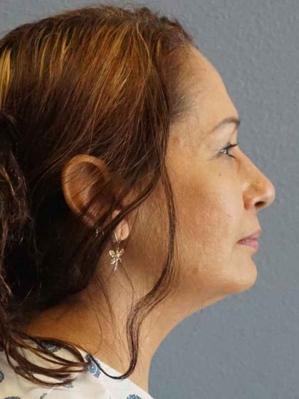 Liposuction of the Neck Before & After Patient #8307