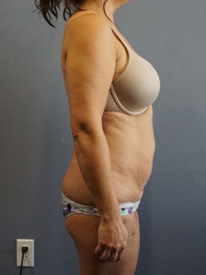 Liposuction Female Before & After Patient #7885