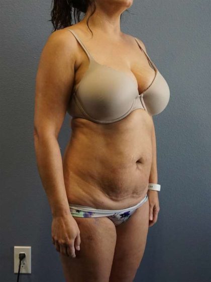 Liposuction Female Before & After Patient #7885