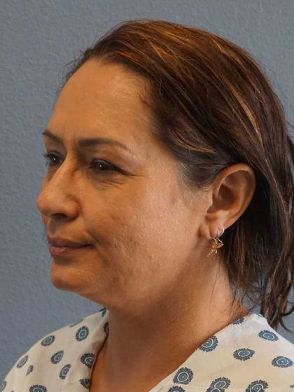 Liposuction of the Neck Before & After Patient #8307
