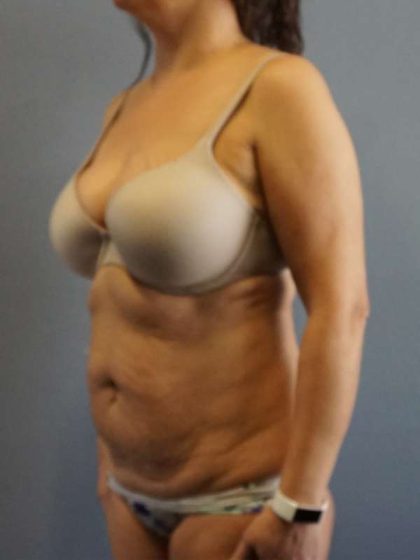Liposuction Female Before & After Patient #7885
