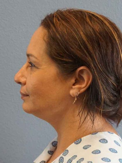Liposuction of the Neck Before & After Patient #8307