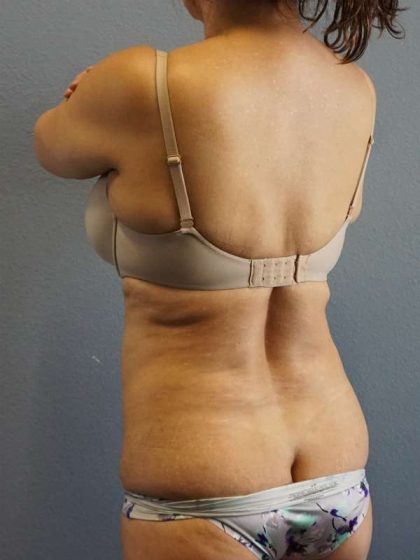 Liposuction Female Before & After Patient #7885