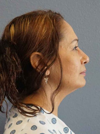 Liposuction of the Neck Before & After Patient #8307