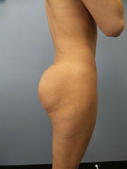Brazilian Butt Lift Before & After Patient #4868