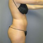 Brazilian Butt Lift Before & After Patient #4868