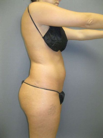 Brazilian Butt Lift Before & After Patient #4868