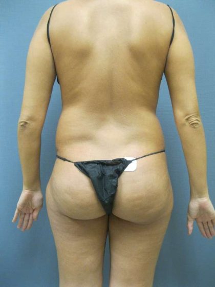 Brazilian Butt Lift Before & After Patient #4868