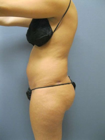 Brazilian Butt Lift Before & After Patient #4868