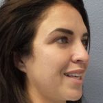 Rhinoplasty Before & After Patient #9969