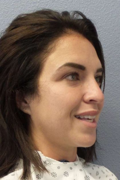 Rhinoplasty Before & After Patient #9969