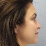 Rhinoplasty Before & After Patient #9969